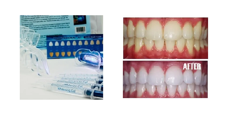 Home Teeth Whitening 3D System Only $9.99! (Reg. $100)
